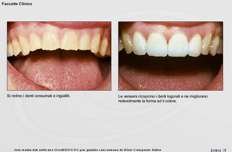 Esempi di trattamento con faccette dentali a Bologna - Centro Odontoiatrico  Grimaldi