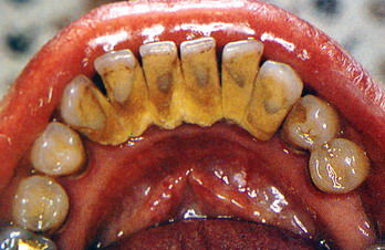 Tartaro sui denti inferiori
